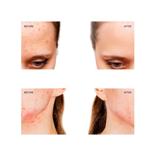 ESPADA™ 2 Dispositivo de tratamiento para el acné Fuchsia FOREO Fuchsia