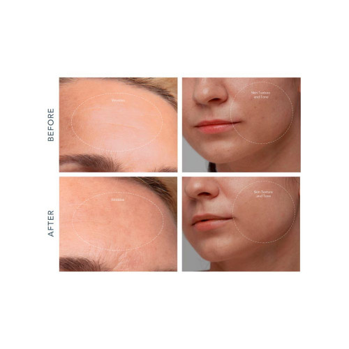KIWI™ derma - Microdermoabrasión con diamantes Adamas y dispositivo de aspiración de poros FOREO Derma