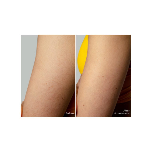 PEACH™ 2 go - Dispositivo IPL con sistema de enfriamiento de la piel para una depilación permanente Peach FOREO Peach